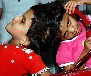 Conjoined twins Veena, Vani (Express Photo/RVK Rao)