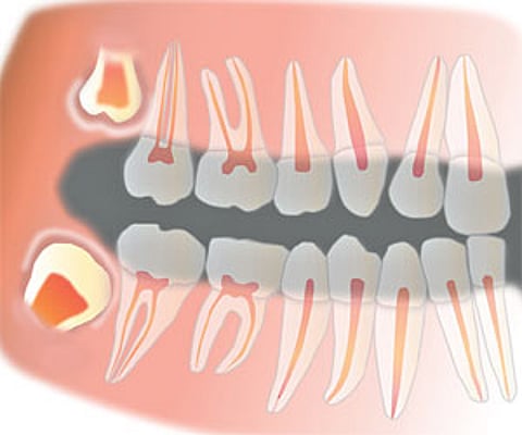 Wisdom behind wisdom tooth