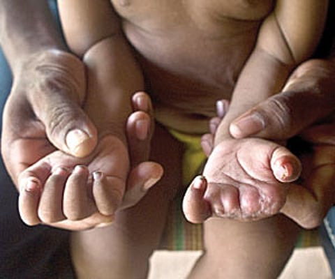 Madvi Mukesh, 18 months, is missing three fingers, lost when security forces allegedly killed his mother.