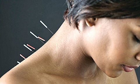 The many benefits of acupuncture