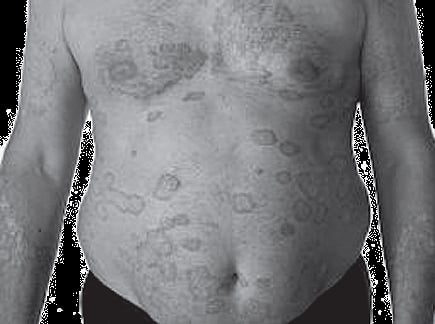 Know Psoriasis and Ways to Cure it