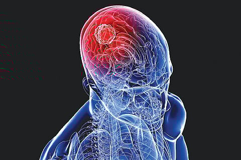 Simple Test Measures Parkinson's Progress in Brain