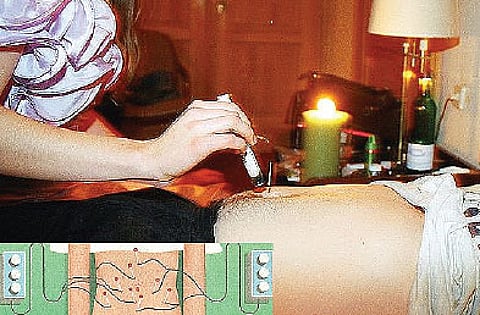 Electro-Acupuncture, an Effective Way to Zap That Fat Forever