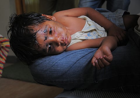 Man burns lover's kids with cigarette butts to make them earn more alms, thrashed