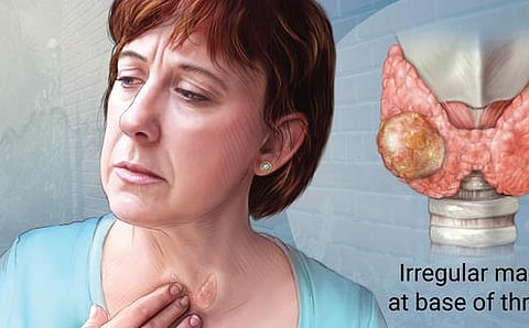 Face thyroid cancer with courage!