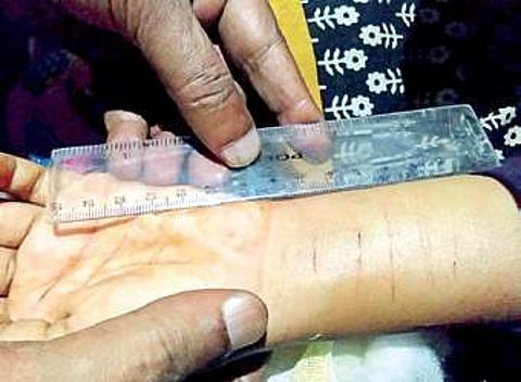 Girl inflicted injury on herself fearing a boy who troubled her regularly