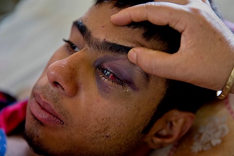 Tabish Bhat, whose eye was damaged after CRPF fired pellets at him during a protest. (File | AP)