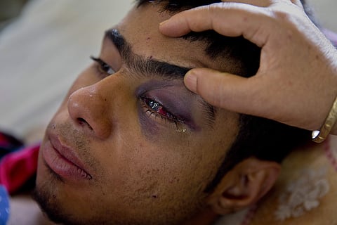 Tabish Bhat, whose eye was damaged after CRPF fired pellets at him during a protest. (File | AP)
