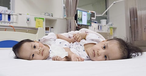 The 15-month-old girls before surgery at the Royal Children's Hospital Melbourne, Australia, Nov. 9, 2018. (Photo | RCH Melbourne Creative Studio via AP)