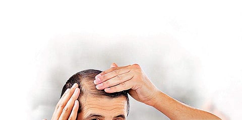 Bald truth: Fighting a receding hairline