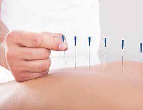 Acupuncture effective in managing acute pain
