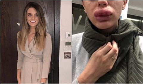 Rachael Knappier before and after the filler injection. (Photo | Facebook)