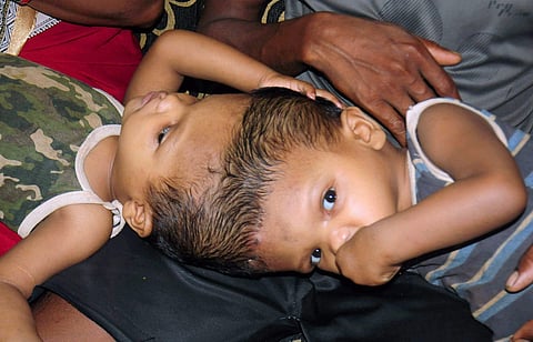 The conjoined twins from Odisha who were later separated by surgical means. (File photo | EPS)