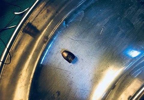 Bullet removed from Dr Kafeel Khan's brother Kashif Jameel's body. (Photo | Twitter/Kafeel Khan)