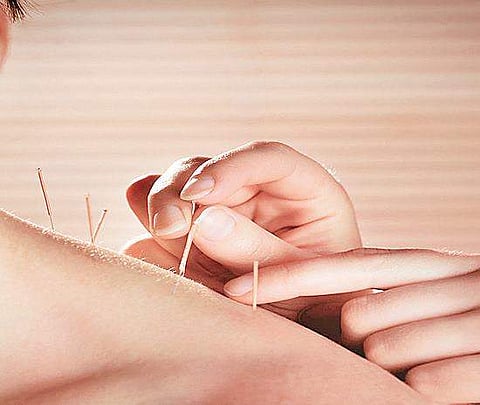 The author applied Tung’s special acupuncture on traditional acupoints to treat shoulder periarthritis, and got a remarkable result.