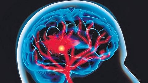 Stroke is caused by disruption of blood supply to the brain.