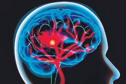 Stroke occurs when there is sudden loss/reduced blood supply to brain, that results in brain cells dying immediately.