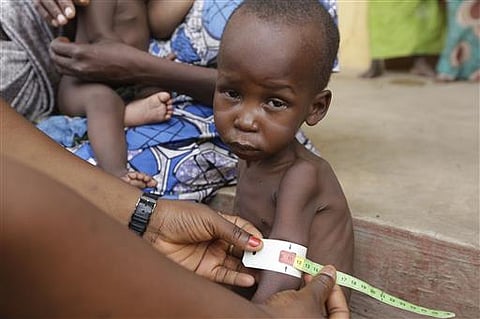 In this Sunday, May. 3, 2015 file photo a doctor attends to a malnourished child at a refugee camp in Yola, Nigeria. (File Photo | AP)