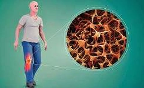 Take care of bone bank deposit before it’s too late