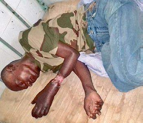 Patient suffering from hypopigmented band was given appointment for doppler test after four months | Express