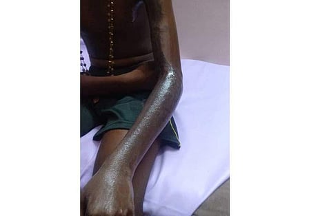 One of the students with burn injuries on his hand (Photo | Special arrangement)