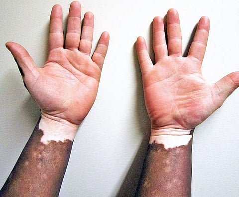 Busting myths about vitiligo, a non-contagious condition