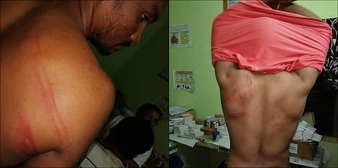 Assault marks on forest staff after they were beaten with sticks by land encroachers in Telangana's Thimmampet on Tuesday morning. (Photo | EPS)