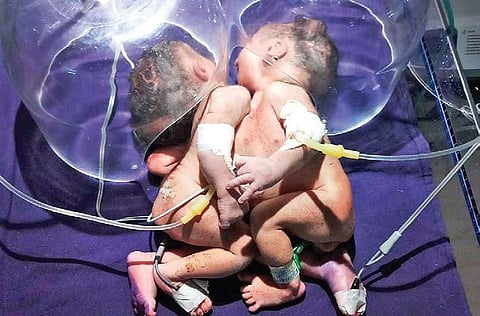 The conjoined sisters under observation at Dhenkanal DHH on Monday. ( Photo | EPS)