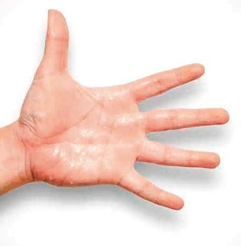 Bengaluru youth gets relief from sweaty palms after surgery