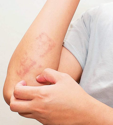 Psoriasis cannot be cured but controlled with biological therapies.