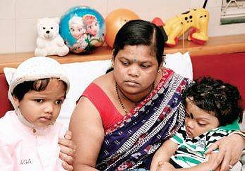 Separated conjoined twins Jaga-Balia