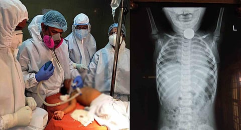 The child had taken food just before swallowing the coin, so the doctors had to wait for about four hours to administer anaesthesia. (Photo | Special Arrangement)