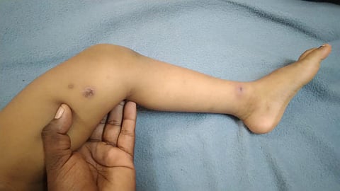 Residents develop blisters, rashes and sores that flare up every time they take a bath or use the water. (Photo | Express)