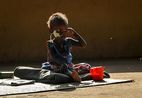Two year old Akon Morro, who is anemic and suffers from edema due to malnutrition, sits on the floor of a feeding center in Al Sabah Children's Hospital in the capital Juba, South Sudan.(Photo | AP)