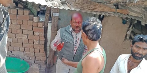 One of the farmers who was injured in the mob attack in Dhar district of Madhya Pradesh. (Photo | EPS)