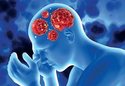 Image for representation for Parkinson's Disease.