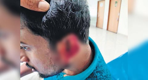 Dr Sakil Khan whose ears were bitten off by Tarini Mohapatra, on refusal to the entry inside the labour room.