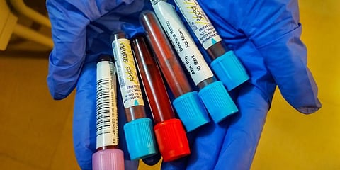 A medic shows samples collected for tests. (Photo | PTI)