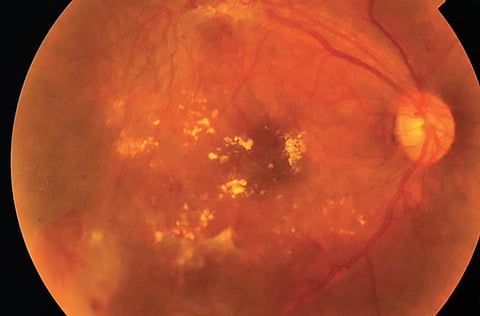 Figure showing severe stage of diabetic retinopathy which is vision threatening and warrants intervention with laser and ocular injections