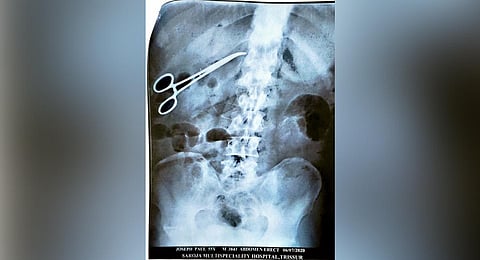The X-ray revealed the presence of the forceps inside Joseph's body. (Photo | Special Arrangement)