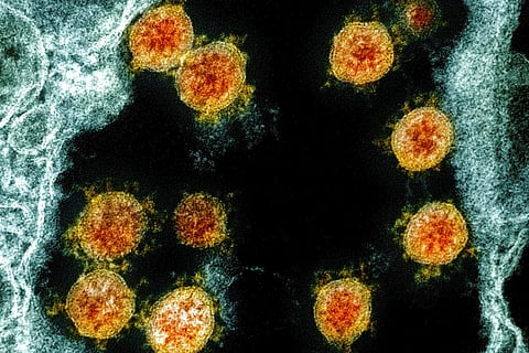 University of Hong Kong scientists claim to have the first evidence of someone being reinfected with the virus that causes COVID-19. (Photo | AP)