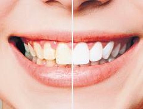 Veneer secret to golden smile