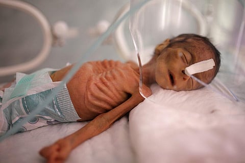 A malnourished newborn baby lies in an incubator at the Al-Sabeen Hospital in Sanaa, Yemen (Photo | AP)