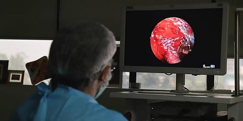 A doctor performs extended functional endoscopic sinus surgery on a person suffering from mucormycosis at a hospital in Ghaziabad. (File photo | AP)