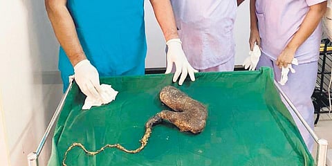 The one kg of bezoar, which was removed from the 15-year-old girl's abdomen who suffered Rapunzel Syndrome, in Villupuram. (Photo| EPS)