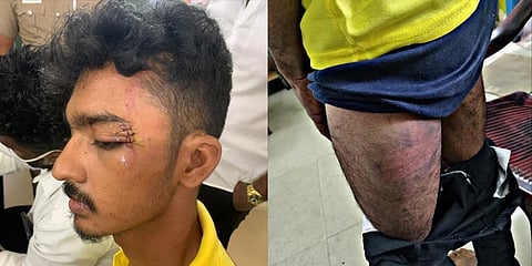 Law student Abdul Raheem who suffered injuries after he was beaten up by the police (Photo | Special Arrangement)