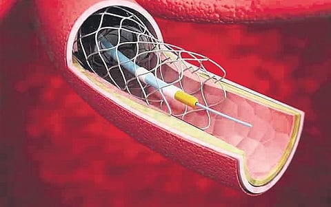Coronary stents in essential medicines list, to get cheaper