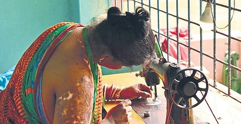 It is assumed that a disfigured girl has no place in society. It becomes extremely difficult for them to be accepted in society as they used to be.