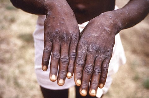 The dorsal surfaces of the hands of a monkeypox case patient, who was displaying the appearance of the characteristic rash during its recuperative stage.(File | AP)
