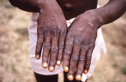 This 1997 image provided by the CDC during an investigation into an outbreak of monkeypox, which took place in the Democratic Republic of the Congo (DRC).